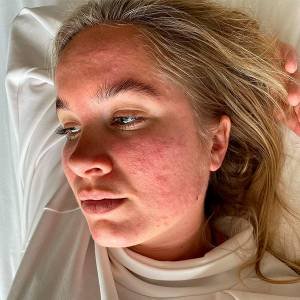 Como identificar a acne por estresse da acne hormonal