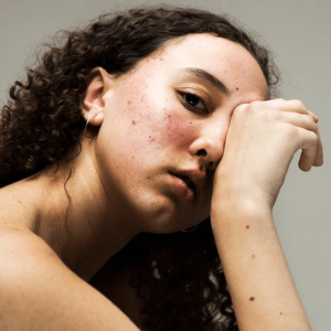 S.O.S. maskne: dicas infalíveis para prevenir e tratar a acne causada pela máscara facial