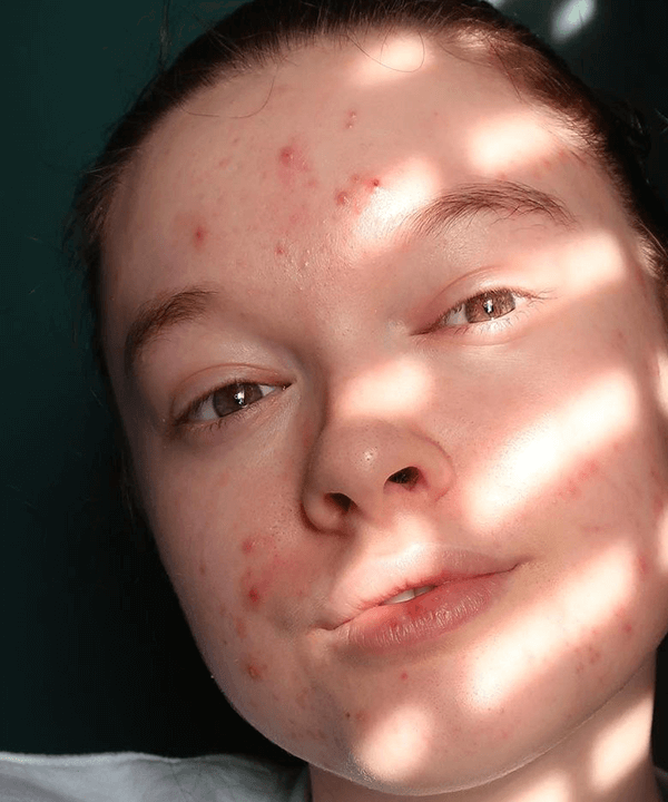 modelo acne  - acne - acne - outono - brasil - https://stealthelook.com.br
