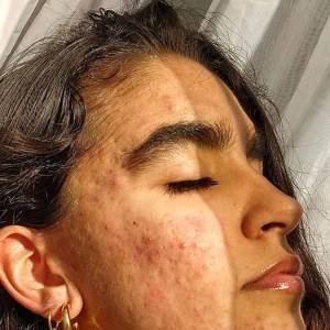 A pandemia pode ter feito você desenvolver acne