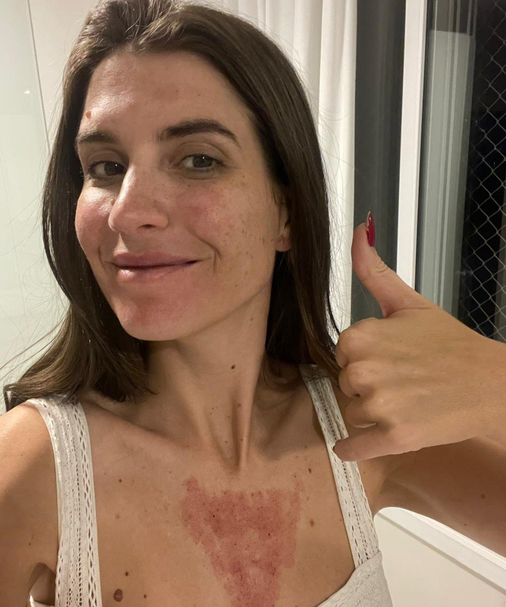 Manuela Bordasch - skincare-cuidados-com-pele - laser fotona - outono - brasil - https://stealthelook.com.br