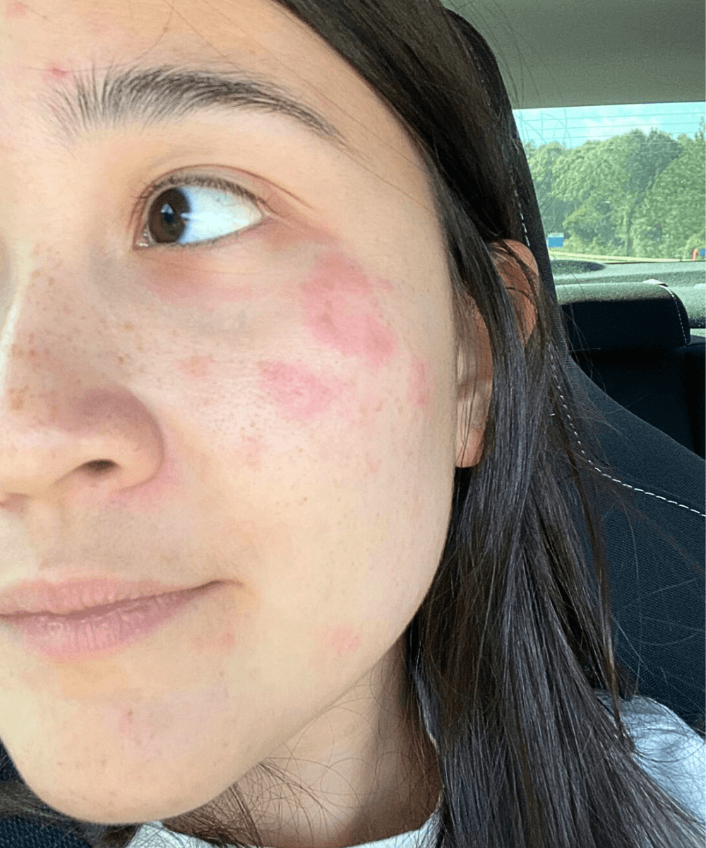 Izabela Suzuki -     - dermatite atópica - inverno - foto de rosto mostrando alergias vermelhas e secas - https://stealthelook.com.br
