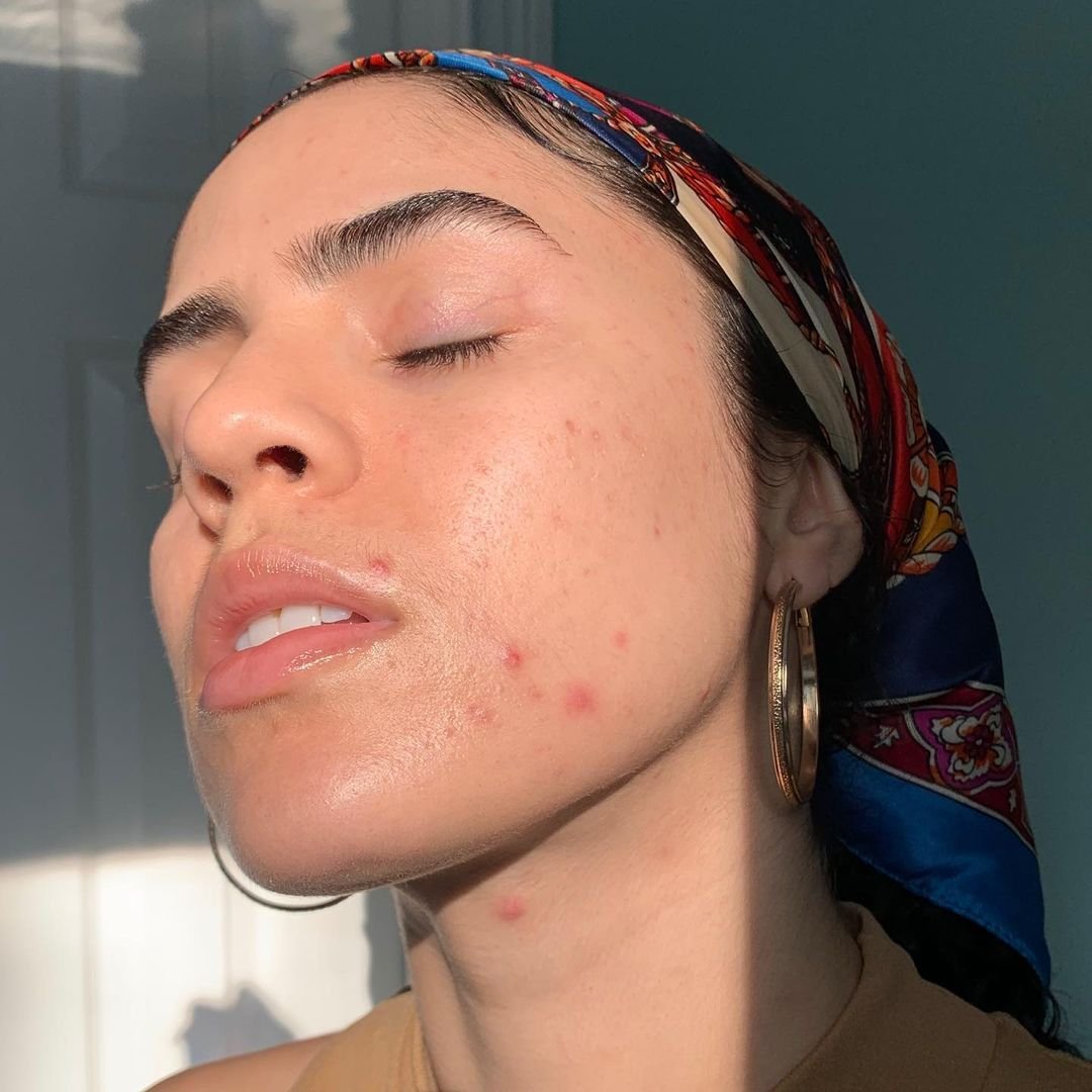 @realskinstory - skincare-pele-acne - pele oleosa - inverno - brasil - https://stealthelook.com.br