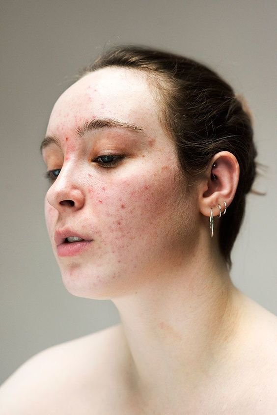 mulher acne - básica - pele emocional - outono - Brasil - https://stealthelook.com.br