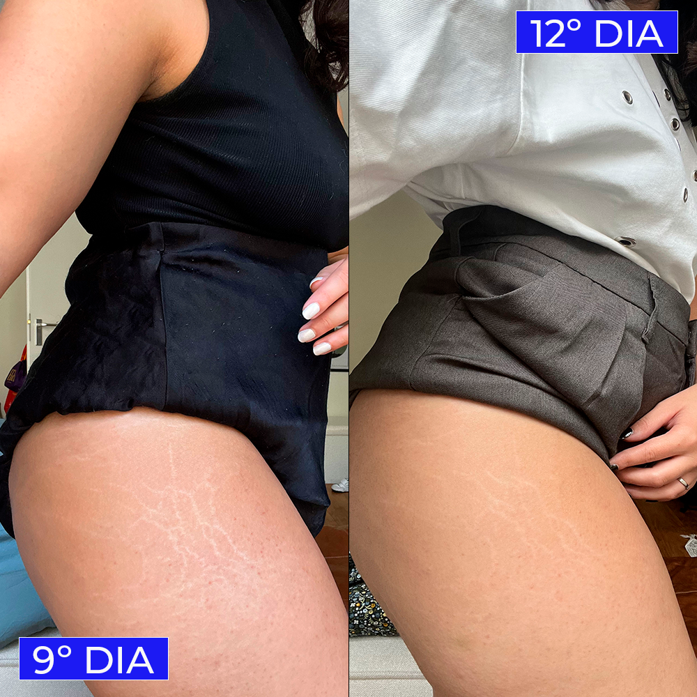 Imagem comparativa mostra evolução de um tratamento ao longo de 9 e 12 dias. Uso de roupas modernas como shorts de cintura alta em tons neutros, combinados com blusas de alças e camisa branca.