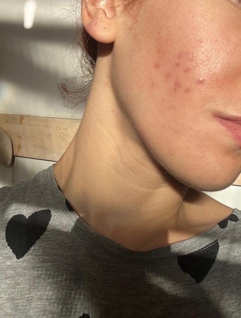 Minha experiência com a acne adulta e o tratamento com Roacutan