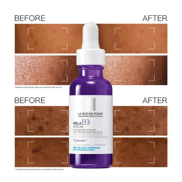 Sérum La Roche-Posay Mela B3 mostra antes e depois com melhorias nas manchas na pele.