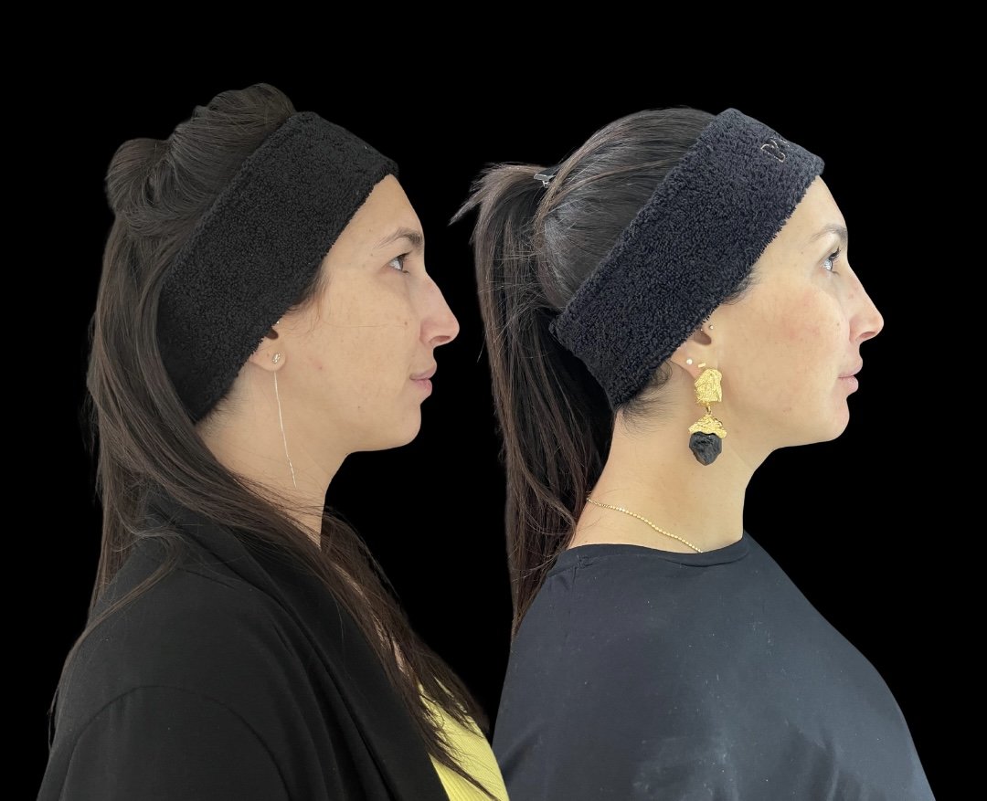 Rostos de mulher antes e depois da harmonização facial, destacando diferenças sutis no contorno e expressão.