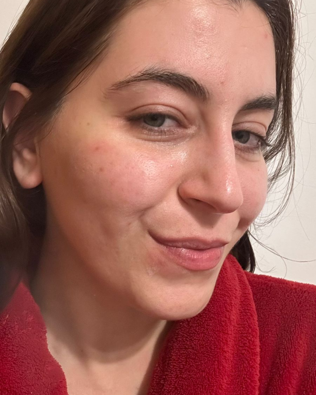 Mulher em close com pele natural e leve vermelhidão para aplicar o adesivo para espinha. 