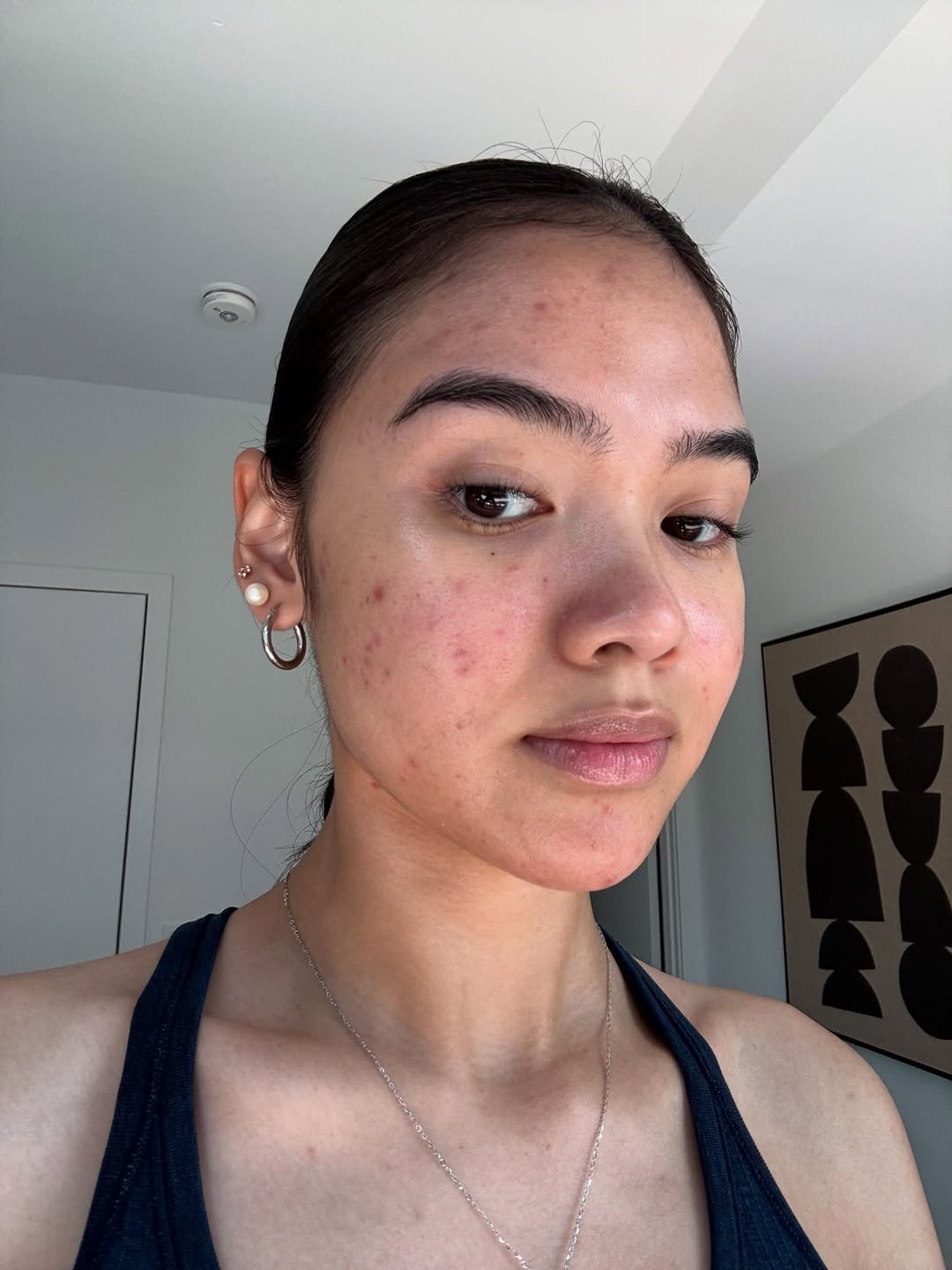 Mulher jovem com espinhas no rosto, relacionadas à acne adulta, em ambiente fechado.