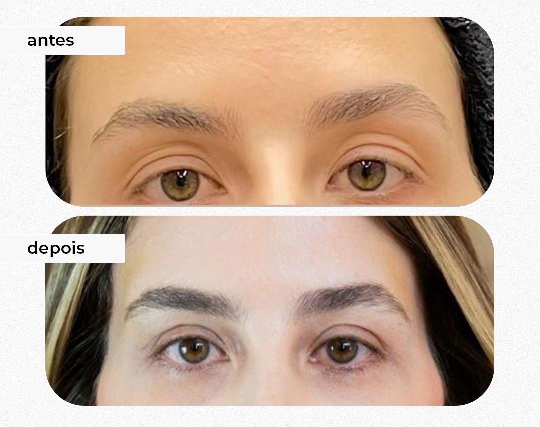 Antes e depois da blefaroplastia, mostrando diferença nas pálpebras e sobrancelhas.