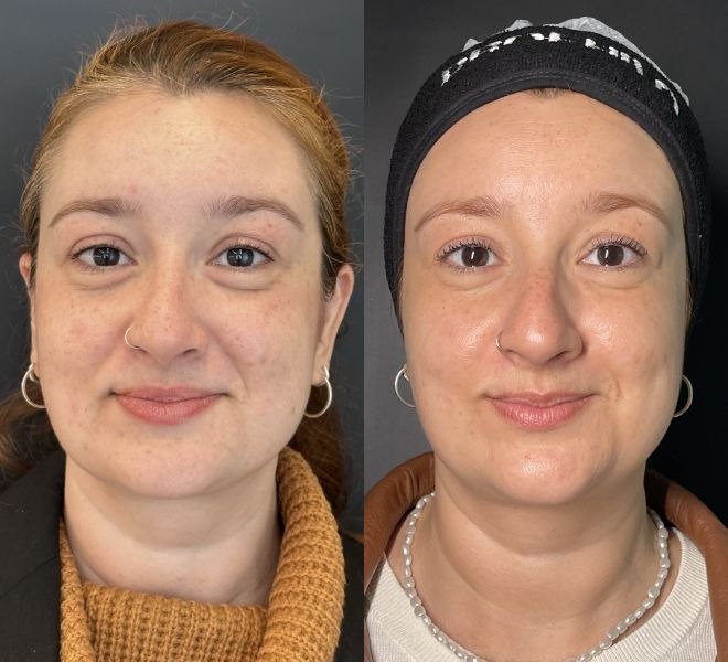 A imagem apresenta duas mulheres em um contexto de tratamento dermatológico. À esquerda, a mulher exibe uma pele com marcas e um visual mais natural, enquanto à direita, sua pele parece mais uniforme e iluminada, sugerindo o efeito positivo de um