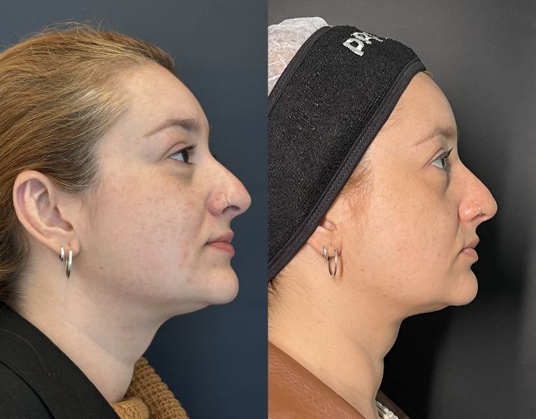 A imagem mostra o perfil de uma mulher antes e depois de um tratamento dermatológico. À esquerda, a pele apresenta manchas e imperfeições, enquanto à direita, a pele parece mais uniforme e suave.