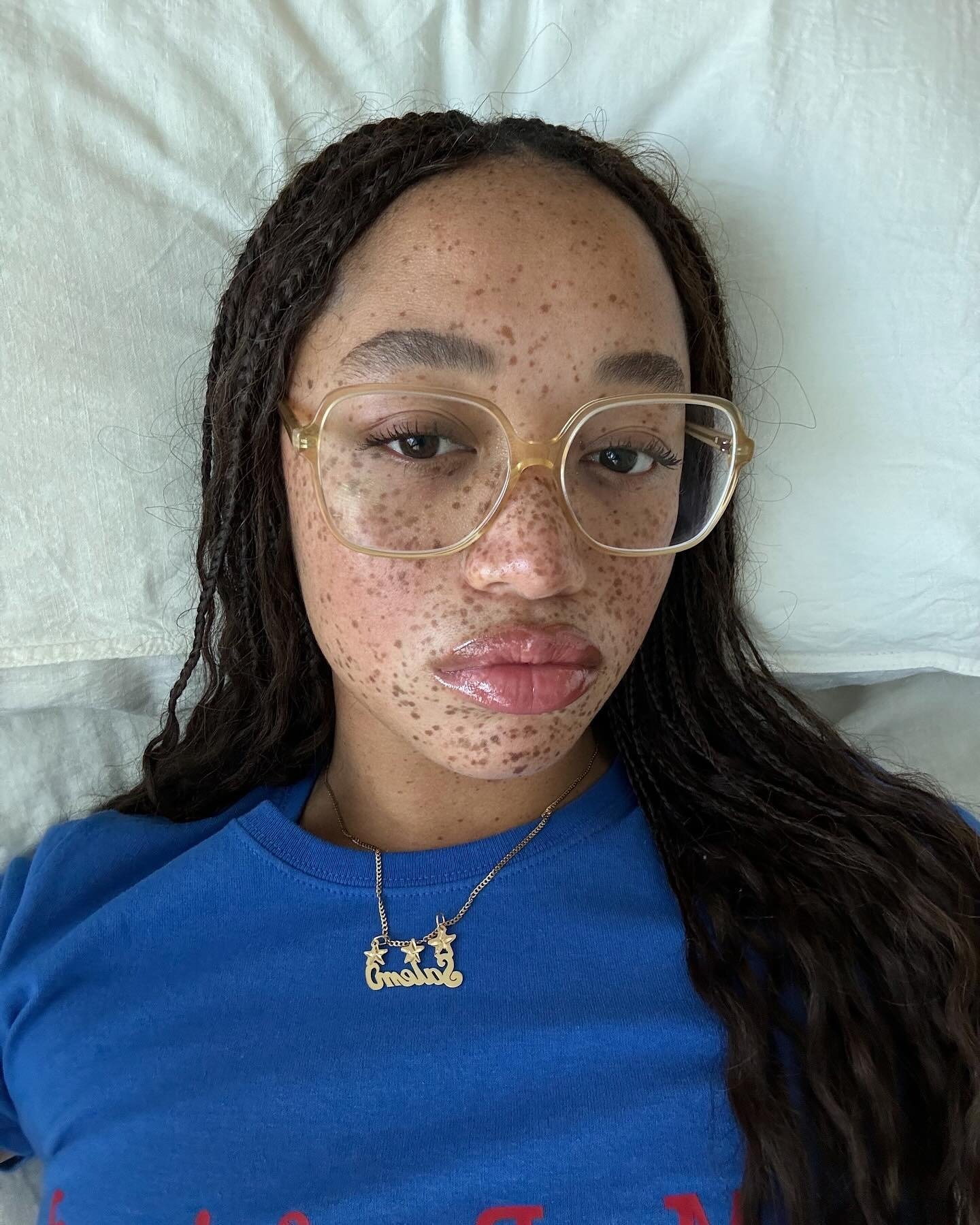 A imagem mostra uma jovem com pele salpicada de sardas, usando óculos grandes e lábios bem hidratados, com um brilho