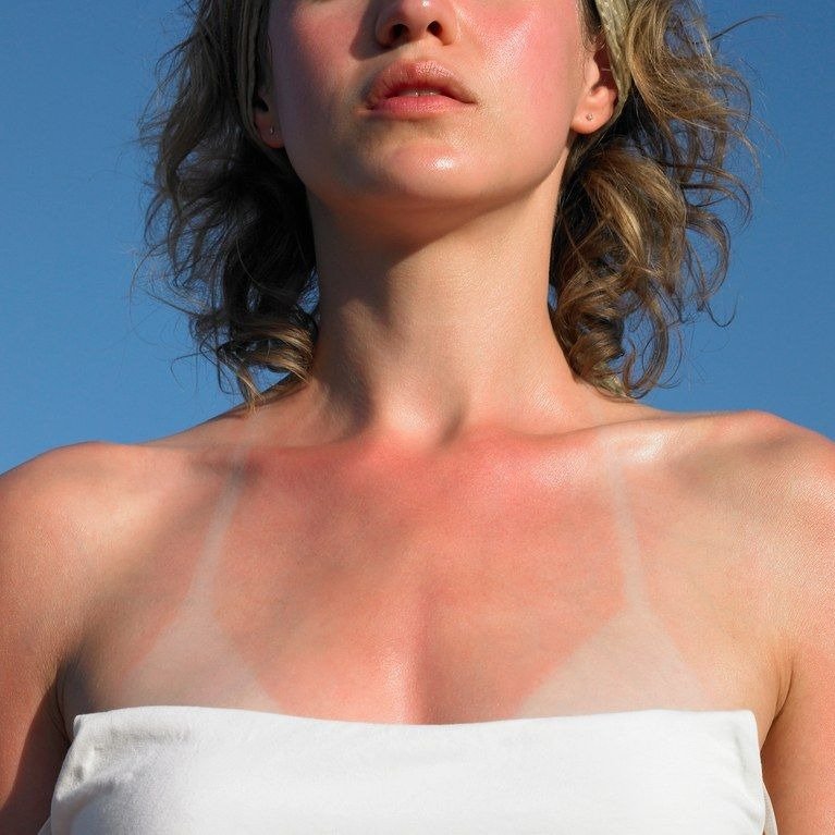 Mulher com pele descascando por causa do sol, usando top branco de alças finas, sob céu azul claro, em clima de alerta.