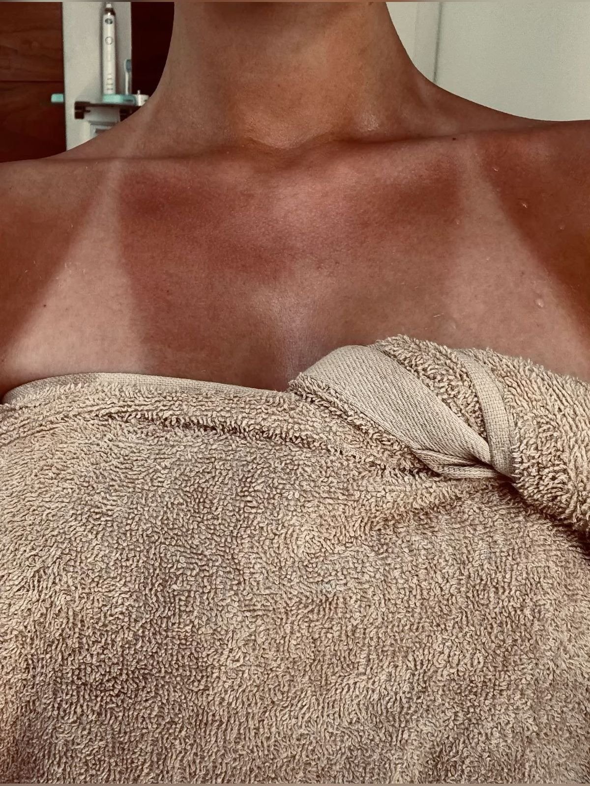 Pele descascando por causa do sol destaca tom bronzeado irregular no colo, envolto em toalha bege de algodão felpudo
