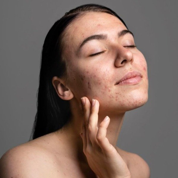 Roacutan: tudo o que você precisa saber antes de começar o tratamento