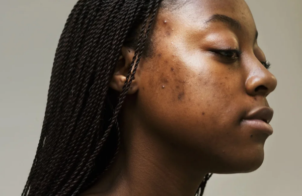 STEAL THE LOOK - WELLNESS - Roacutan: tudo o que você precisa saber antes de começar o tratamento